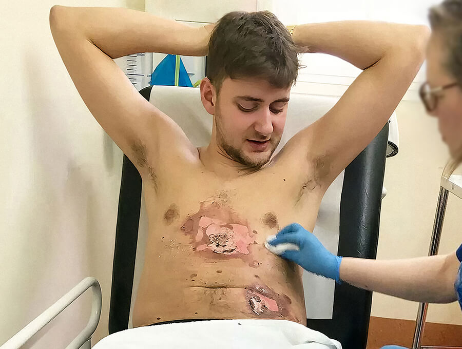 A young man being treated in hospital for vape explosion burns on his chest